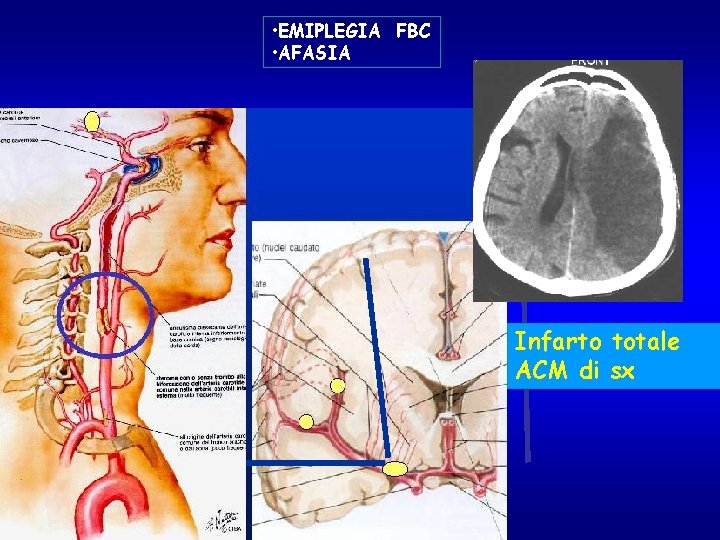  • EMIPLEGIA FBC • AFASIA Infarto totale ACM di sx 