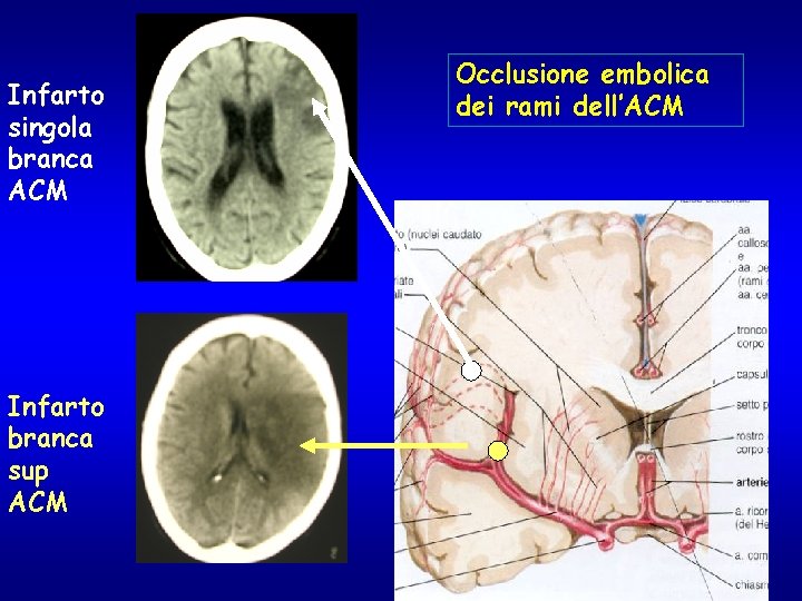 Infarto singola branca ACM Infarto branca sup ACM Occlusione embolica dei rami dell’ACM 