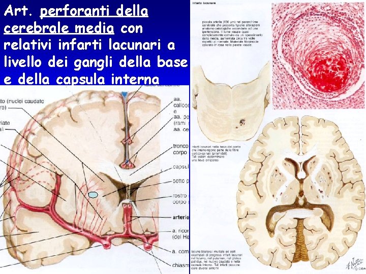 Art. perforanti della cerebrale media con relativi infarti lacunari a livello dei gangli della