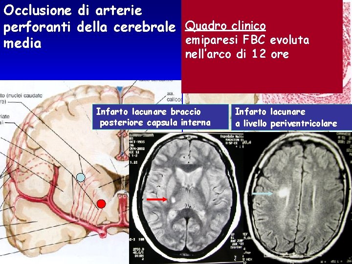 Occlusione di arterie perforanti della cerebrale Quadro clinico emiparesi FBC evoluta media nell’arco di