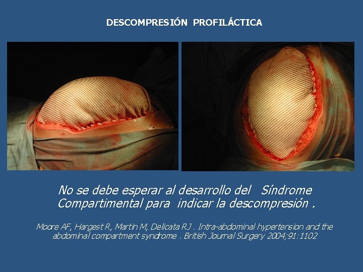 DESCOMPRESIÓN PROFILÁCTICA No se debe esperar al desarrollo del Síndrome Compartimental para indicar la