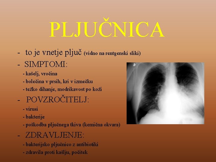 PLJUČNICA - to je vnetje pljuč (vidno na rentgenski sliki) - SIMPTOMI: - kašelj,