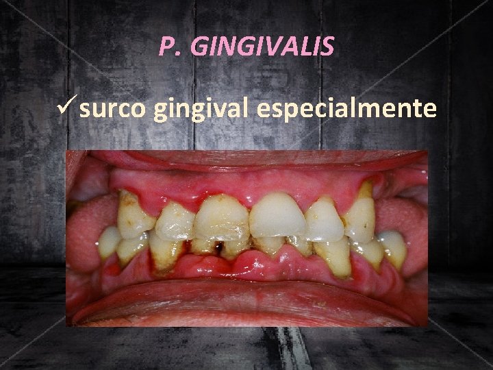P. GINGIVALIS üsurco gingival especialmente 