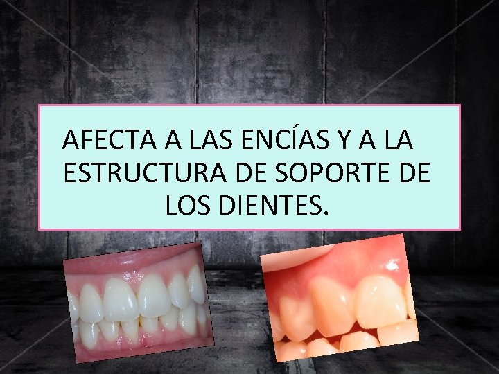 AFECTA A LAS ENCÍAS Y A LA ESTRUCTURA DE SOPORTE DE LOS DIENTES. 