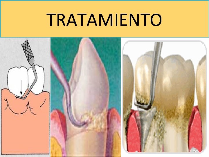 TRATAMIENTO 