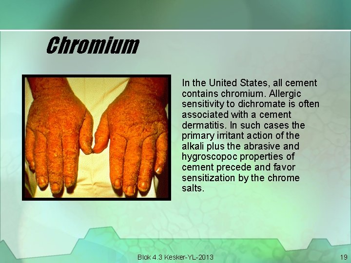 Chromium In the United States, all cement contains chromium. Allergic sensitivity to dichromate is