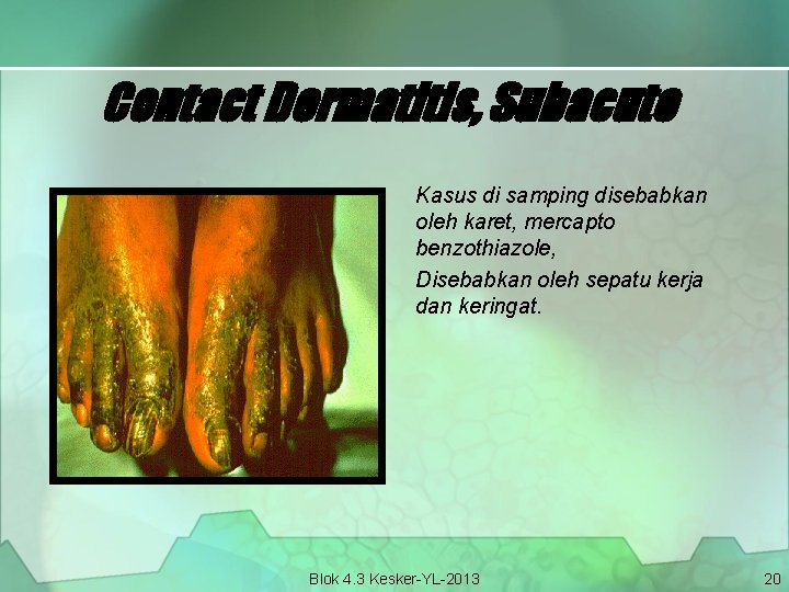 Contact Dermatitis, Subacute Kasus di samping disebabkan oleh karet, mercapto benzothiazole, Disebabkan oleh sepatu