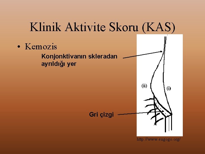 Klinik Aktivite Skoru (KAS) • Kemozis Konjonktivanın skleradan ayrıldığı yer Gri çizgi http: //www.