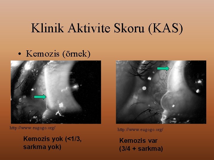 Klinik Aktivite Skoru (KAS) • Kemozis (örnek) http: //www. eugogo. org/ Kemozis yok (<1/3,