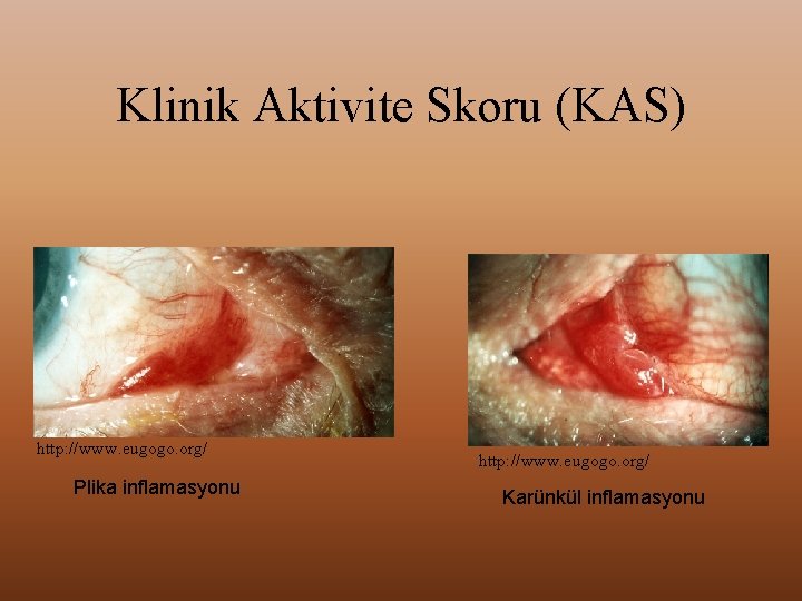 Klinik Aktivite Skoru (KAS) http: //www. eugogo. org/ Plika inflamasyonu http: //www. eugogo. org/