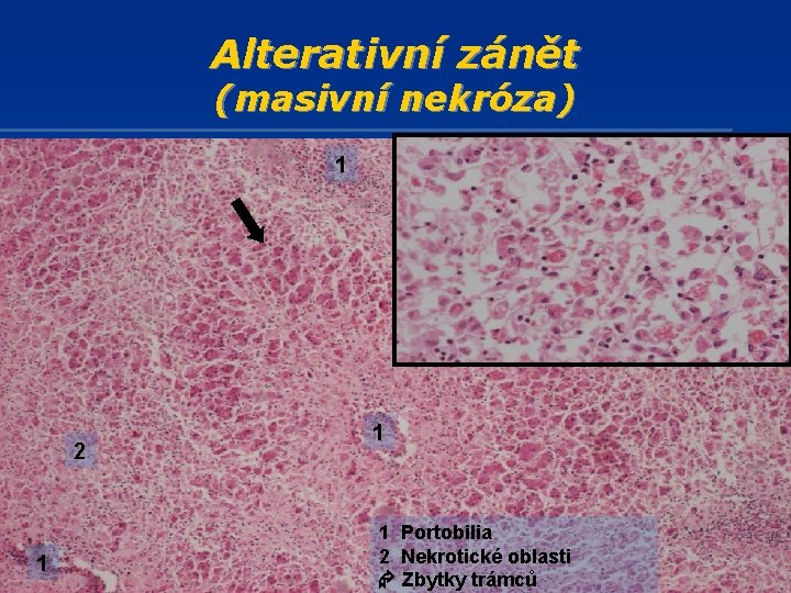 Alterativní zánět (masivní nekróza) 1 2 2 1 1 1 Portobilia 2 Nekrotické oblasti