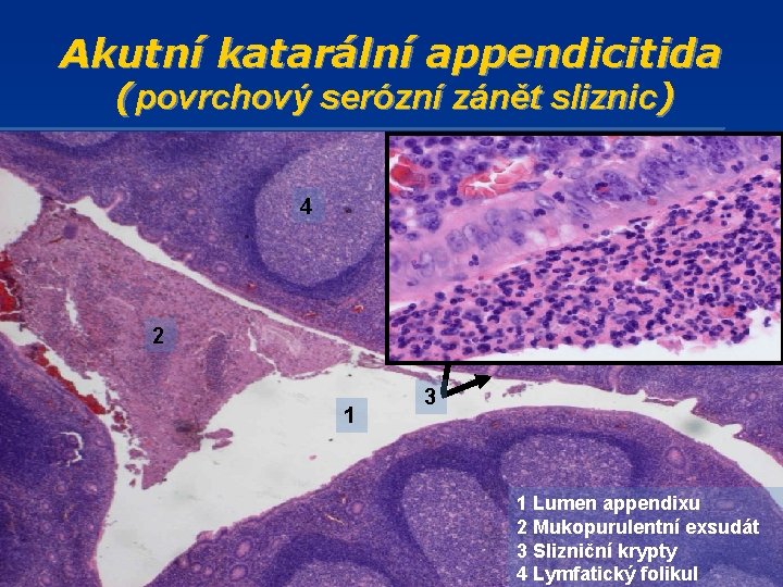Akutní katarální appendicitida (povrchový serózní zánět sliznic) 4 2 1 3 1 Lumen appendixu