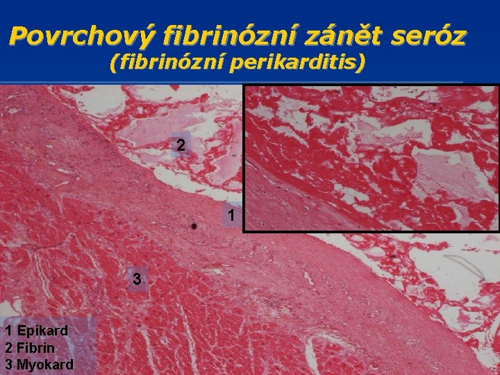 Povrchový fibrinózní zánět seróz (fibrinózní perikarditis) 2 1 3 1 Epikard 2 Fibrin 3