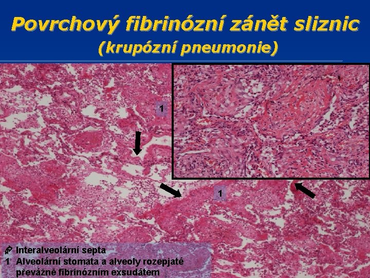 Povrchový fibrinózní zánět sliznic (krupózní pneumonie) 1 1 1 Interalveolární septa 1 Alveolární stomata