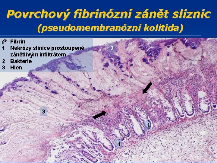 Povrchový fibrinózní zánět sliznic (pseudomembranózní kolitida) Fibrin 1 Nekrózy slinice prostoupené zánětlivým infiltrátem 2