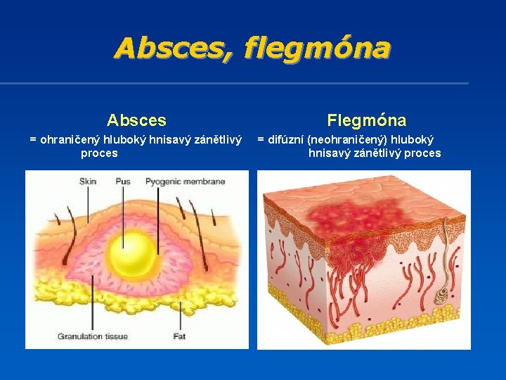 Absces, flegmóna Absces = ohraničený hluboký hnisavý zánětlivý proces Flegmóna = difúzní (neohraničený) hluboký