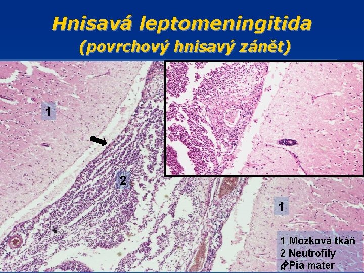 Hnisavá leptomeningitida (povrchový hnisavý zánět) 2 1 1 Mozková tkáň 2 Neutrofily Pia mater