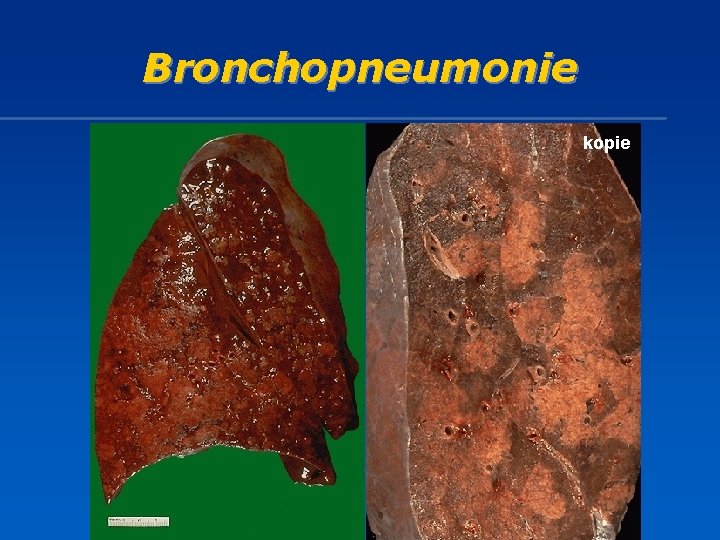 Bronchopneumonie kopie 