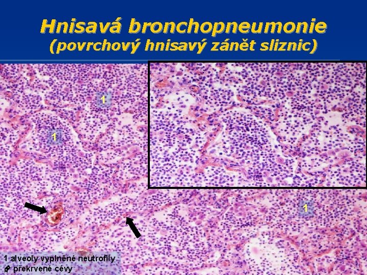 Hnisavá bronchopneumonie (povrchový hnisavý zánět sliznic) 1 1 alveoly vyplněné neutrofily překrvené cévy 