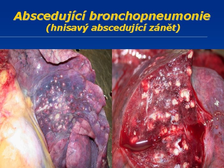 Abscedující bronchopneumonie (hnisavý abscedující zánět) 