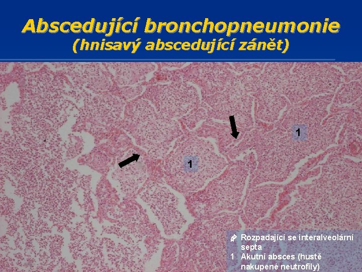 Abscedující bronchopneumonie (hnisavý abscedující zánět) 1 1 Rozpadající se interalveolární septa 1 Akutní absces