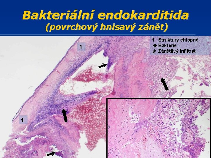 Bakteriální endokarditida (povrchový hnisavý zánět) 1 1 1 Struktury chlopně Bakterie Zánětlivý infiltrát 