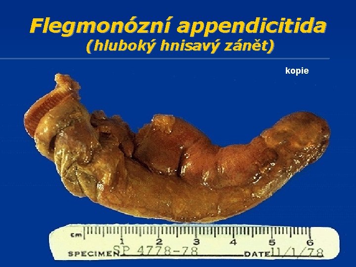 Flegmonózní appendicitida (hluboký hnisavý zánět) kopie 