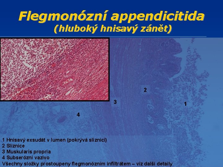 Flegmonózní appendicitida (hluboký hnisavý zánět) 2 3 4 1 Hnisavý exsudát v lumen (pokrývá