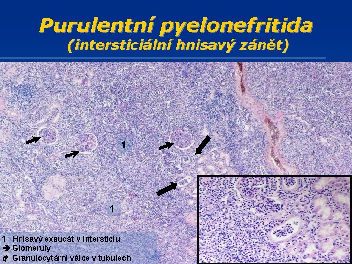 Purulentní pyelonefritida (intersticiální hnisavý zánět) 1 1 1 Hnisavý exsudát v intersticiu Glomeruly Granulocytární