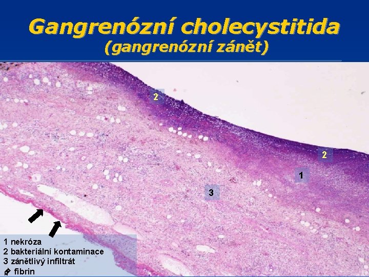 Gangrenózní cholecystitida (gangrenózní zánět) 2 2 1 3 1 nekróza 2 bakteriální kontaminace 3