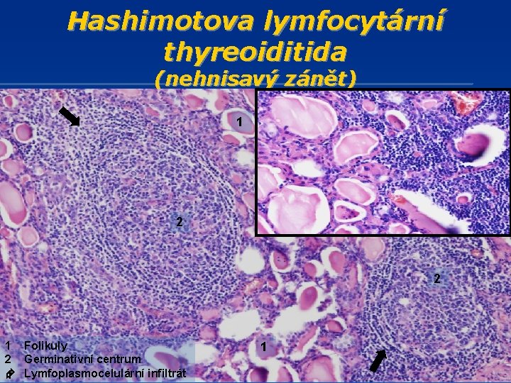 Hashimotova lymfocytární thyreoiditida (nehnisavý zánět) 1 2 2 1 Folikuly 2 Germinativní centrum Lymfoplasmocelulární