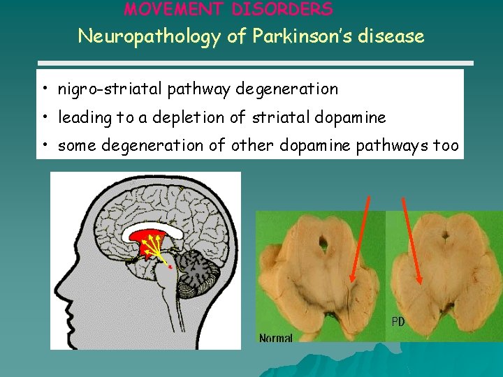 MOVEMENT DISORDERS Neuropathology of Parkinson’s disease • nigro-striatal pathway degeneration • leading to a