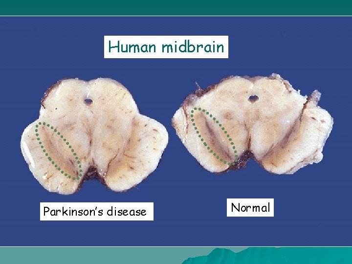 Human midbrain Parkinson’s disease Normal 