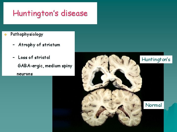 Huntington’s disease u Pathophysiology – Atrophy of striatum – Loss of striatal GABA-ergic, medium