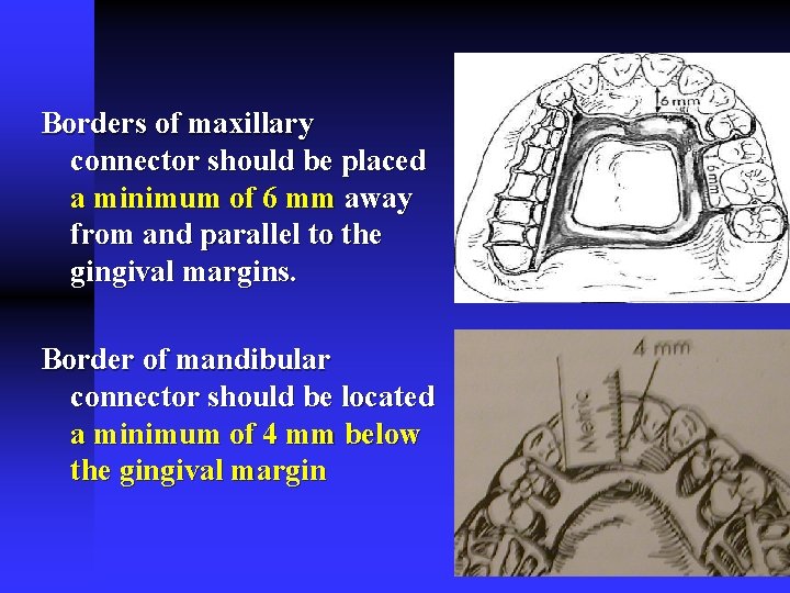 Borders of maxillary connector should be placed a minimum of 6 mm away from