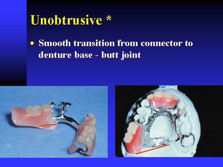 Unobtrusive * · Smooth transition from connector to denture base - butt joint 
