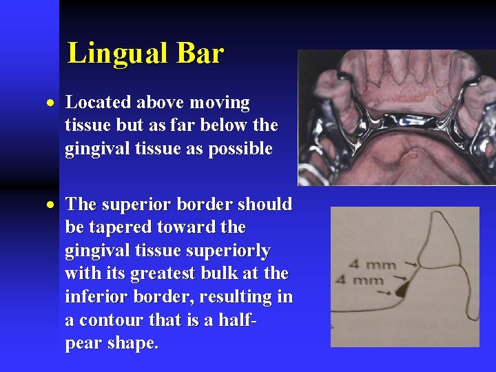 Lingual Bar · Located above moving tissue but as far below the gingival tissue