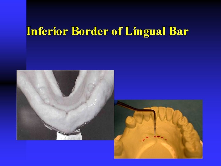 Inferior Border of Lingual Bar 