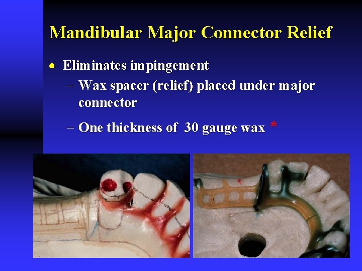 Mandibular Major Connector Relief · Eliminates impingement - Wax spacer (relief) placed under major