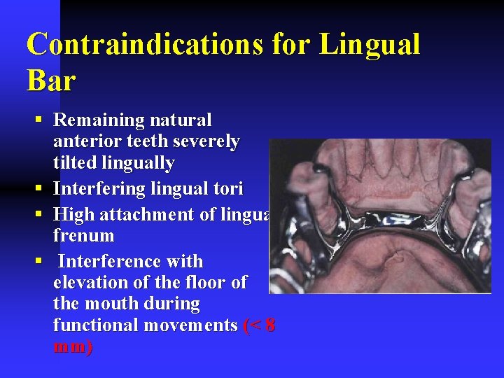 Contraindications for Lingual Bar § Remaining natural anterior teeth severely tilted lingually § Interfering