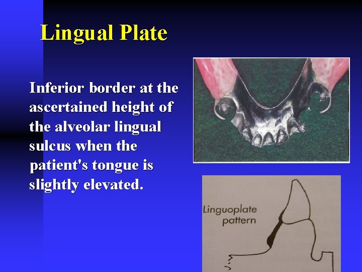 Lingual Plate Inferior border at the ascertained height of the alveolar lingual sulcus when