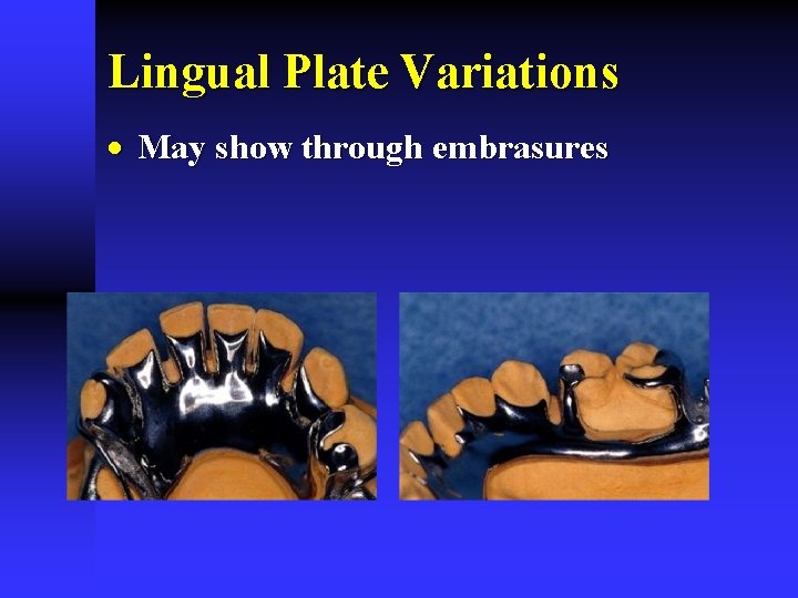Lingual Plate Variations · May show through embrasures 