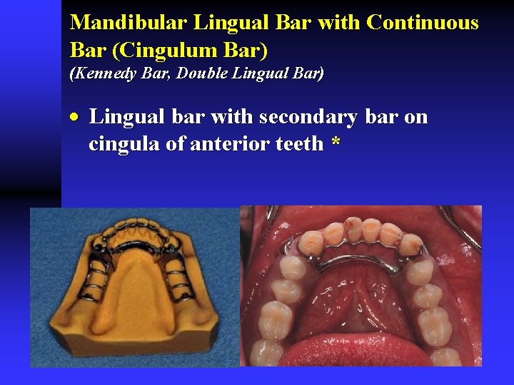 Mandibular Lingual Bar with Continuous Bar (Cingulum Bar) (Kennedy Bar, Double Lingual Bar) ·