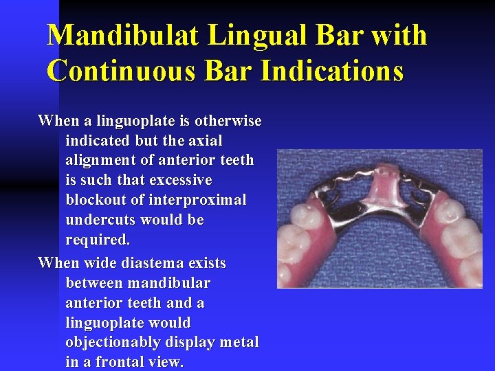 Mandibulat Lingual Bar with Continuous Bar Indications When a linguoplate is otherwise indicated but
