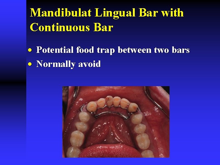 Mandibulat Lingual Bar with Continuous Bar · Potential food trap between two bars ·