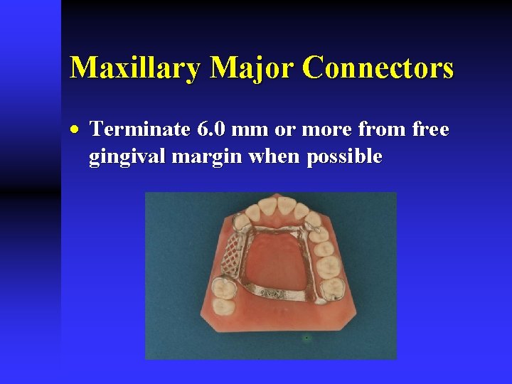 Maxillary Major Connectors · Terminate 6. 0 mm or more from free gingival margin