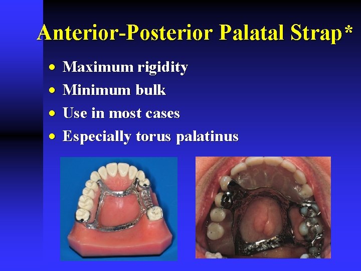 Anterior-Posterior Palatal Strap* · · Maximum rigidity Minimum bulk Use in most cases Especially