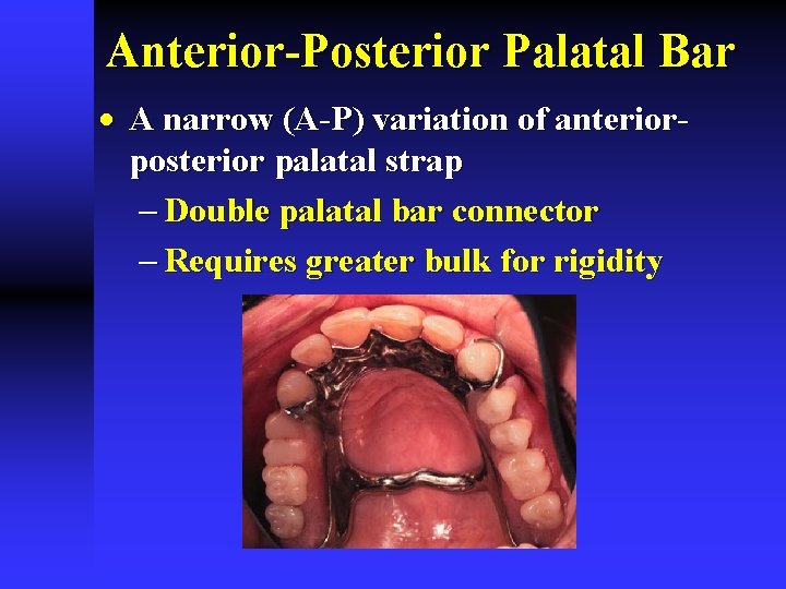 Anterior-Posterior Palatal Bar · A narrow (A-P) variation of anteriorposterior palatal strap - Double