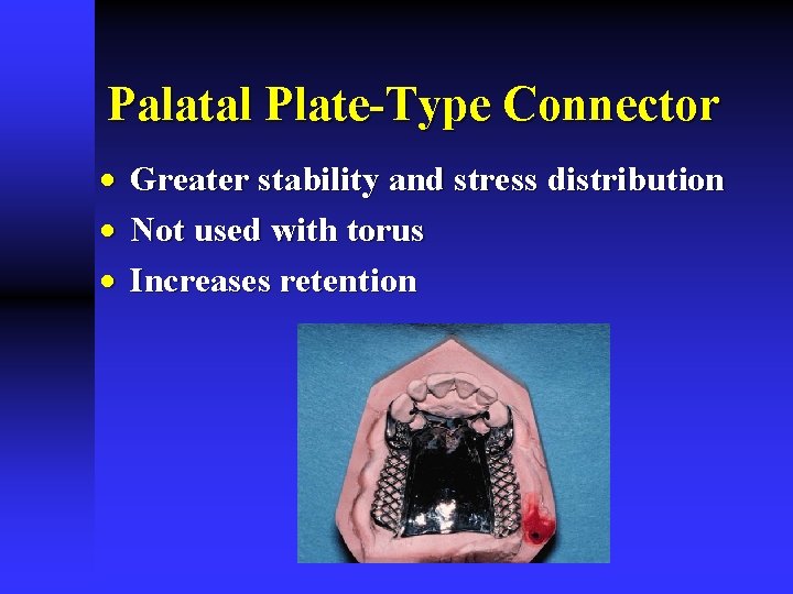 Palatal Plate-Type Connector · Greater stability and stress distribution · Not used with torus