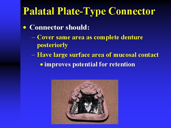 Palatal Plate-Type Connector · Connector should: - Cover same area as complete denture posteriorly